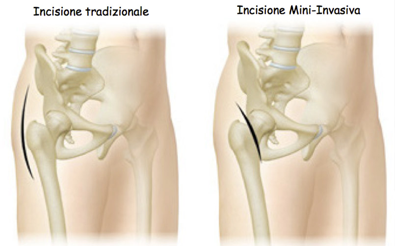 Protesi dell’Anca : ora c’è una nuova tecnica mini invasiva
